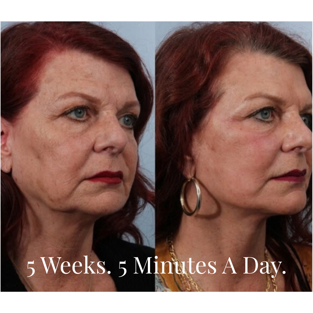 Survora® Halo - Jawline Lifting Wand