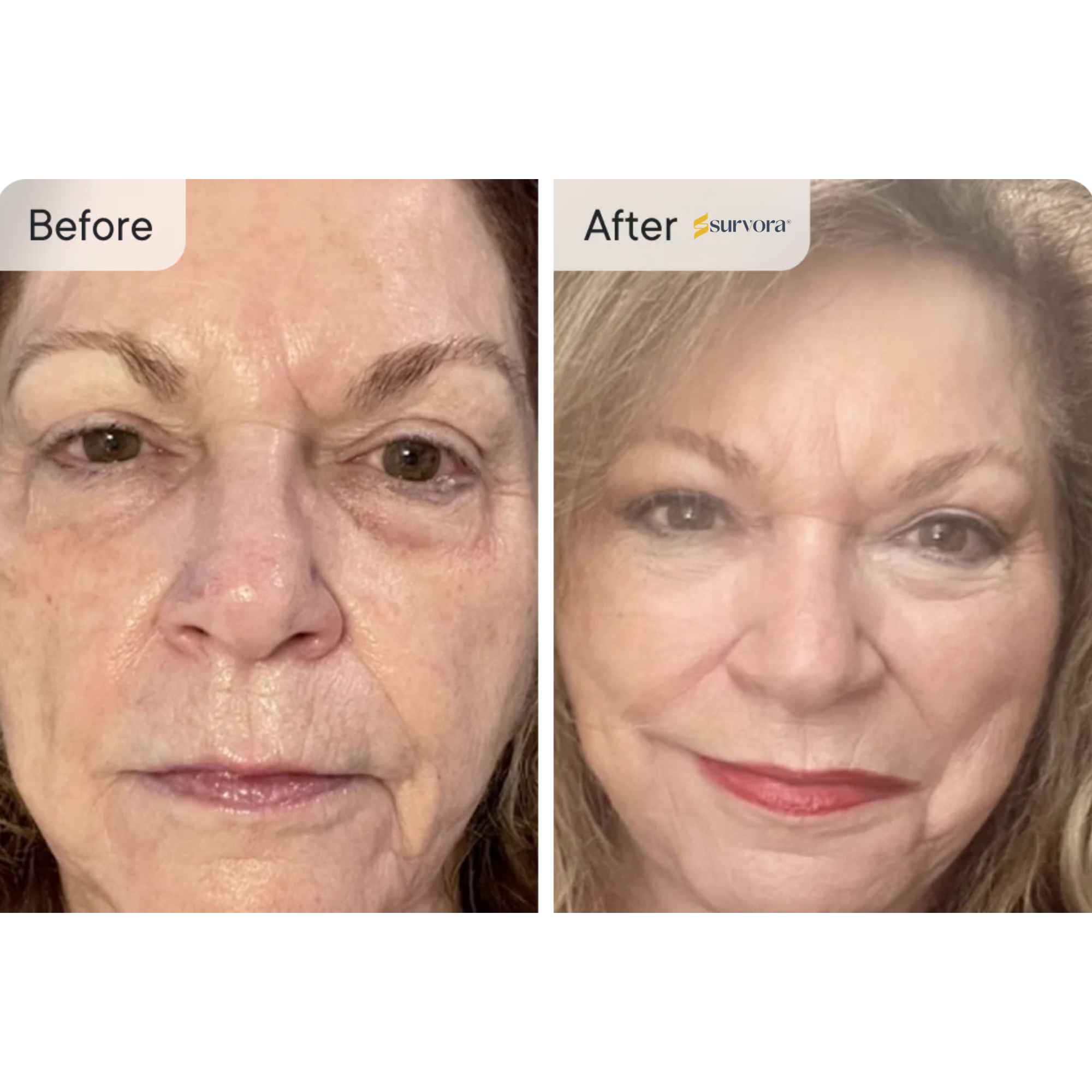 Survora® Halo LED Light Therapy Mask