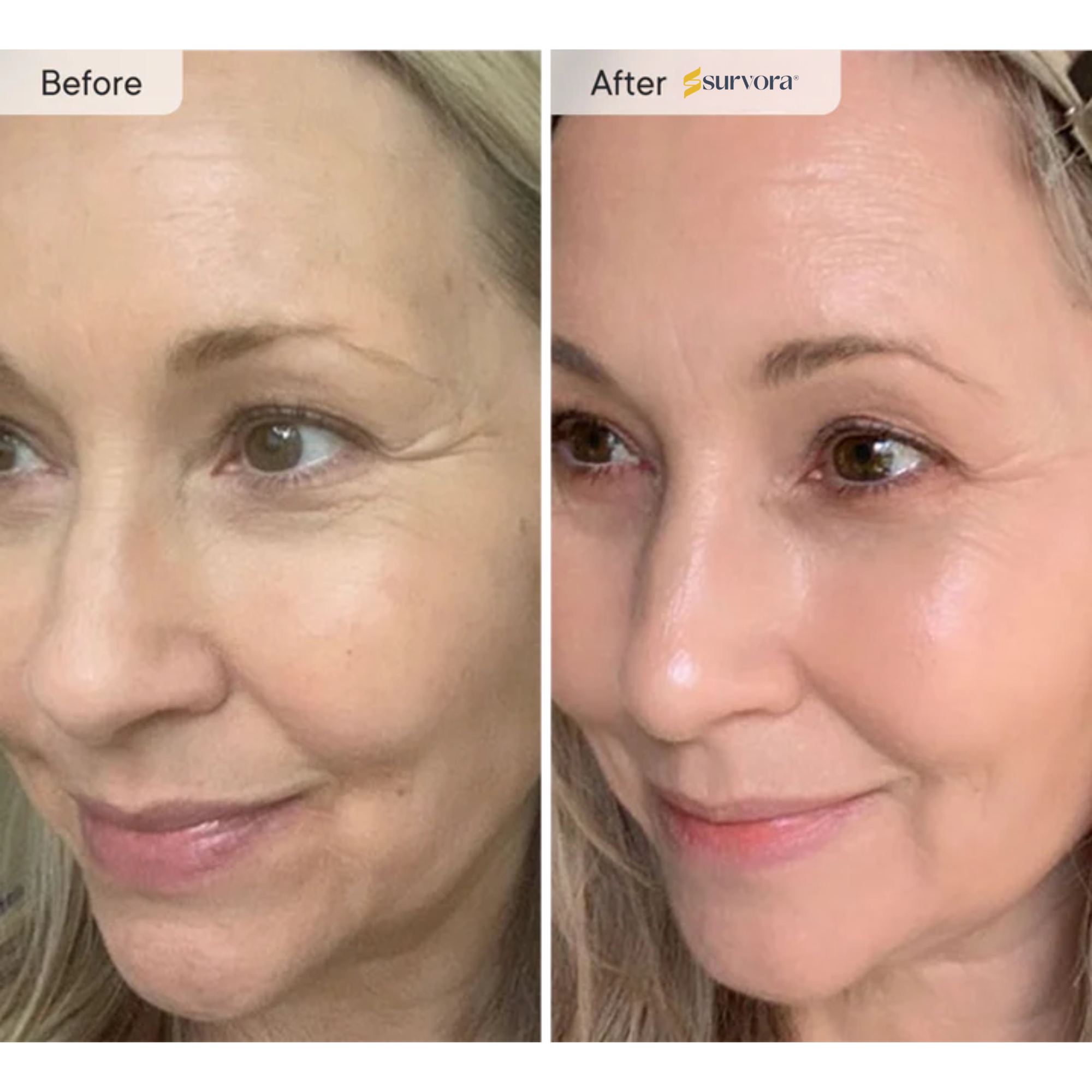 Survora® Halo LED Light Therapy Mask